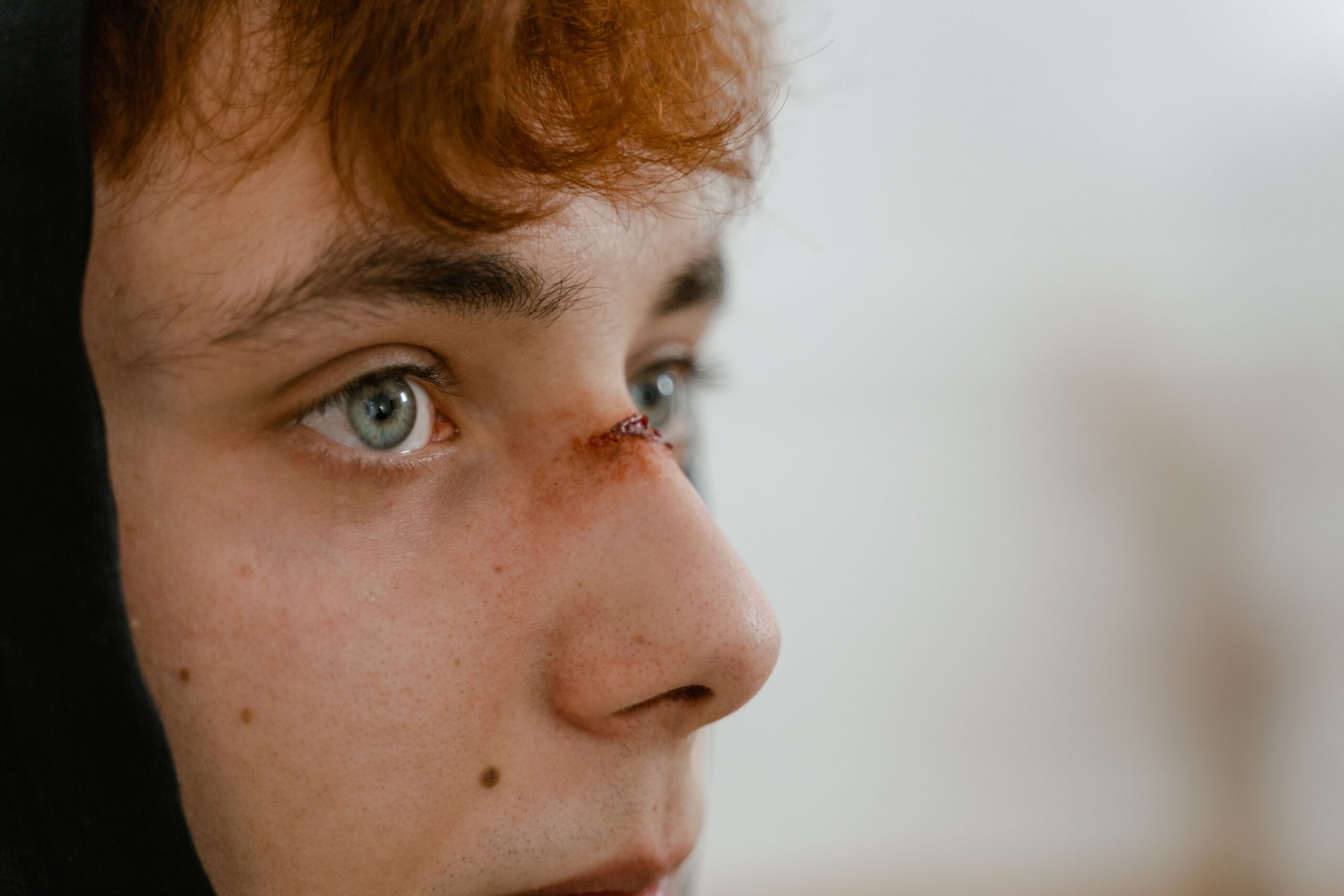 Facial Injuries and Scarring After an Accident in Illinois