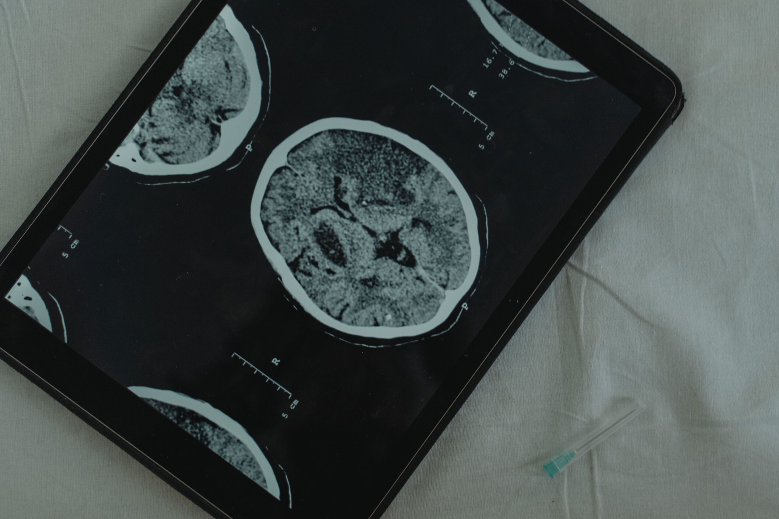 Traumatic Brain Injuries in Illinois Personal Injury Case: The Invisible Injury
